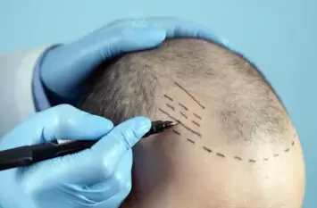 hair-transplante